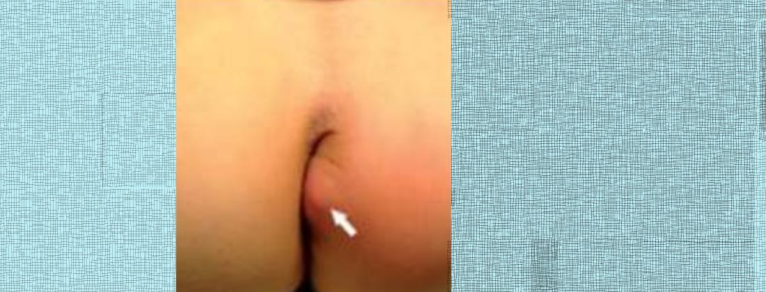 analna fistula slike