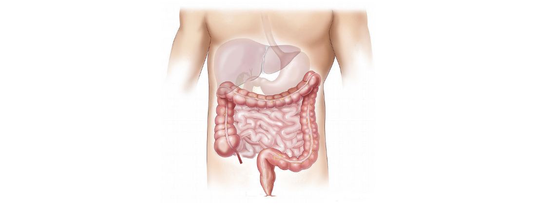 rak debelog creva simptomi